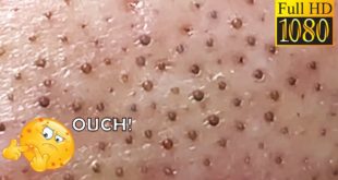 Blackheads! Removing Facial Blackhead, Milia & Cystic Acne – Oct 2, 2020