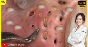 Blackheads! Removing Facial BLACKHEADs – Sep 11, 2020 (Oddly Satisfy)