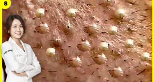 Blackheads! Removing Facial BLACKHEADs and WHITEHEADs in 10 Minutes