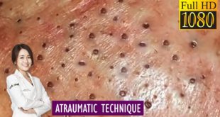 Blackheads! Removing Facial Blackhead, Milia & Cystic Acne – Oct 15, 2020