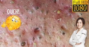 Blackheads! #40 Removing Facial Blackhead, Milia & Cystic Acne – Nov 3, 2020