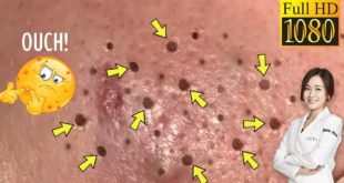 Blackheads! #38 Removing Facial Blackhead, Milia & Cystic Acne – Oct 31, 2020