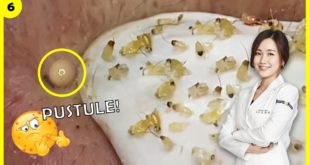 Blackheads! Removing Cyste Acnes and Blackheads in 10 Minutes