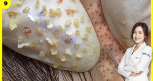 Blackheads! Removing BLACKHEADs on Forehead in 10 Minutes