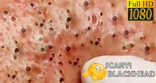 Blackheads! Removing Facial Blackhead, Milia & Cystic Acne – Oct 3, 2020