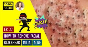 Blackheads! Removing Facial Blackhead, Milia & Cystic Acne – Oct 4, 2020