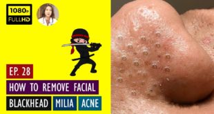 Blackheads! Removing Facial Blackhead, Milia & Cystic Acne – Oct 9, 2020