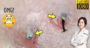 Blackheads! #35 Removing Facial Blackhead, Milia, & Cystic Acne – Oct 19, 2020
