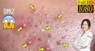 Blackheads! #34 Removing Facial Blackhead, Milia & Cystic Acne – Oct 17, 2020