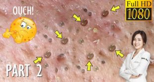 Blackheads! #44 Removing Facial Blackhead, Milia & Cystic Acne – Part 2