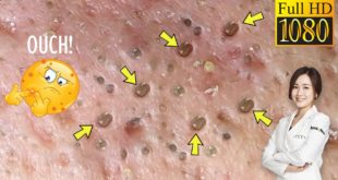 Blackheads! #43 Removing Facial Blackhead, Milia & Cystic Acne – Nov 9, 2020