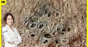 Blackheads! Removing Scary BLACKHEADs on Lady’s Chin in 10 Minutes