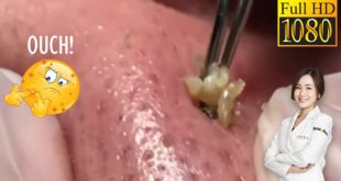 Blackheads! #42 Removing Facial Blackhead, Milia & Cystic Acne – Nov 6, 2020